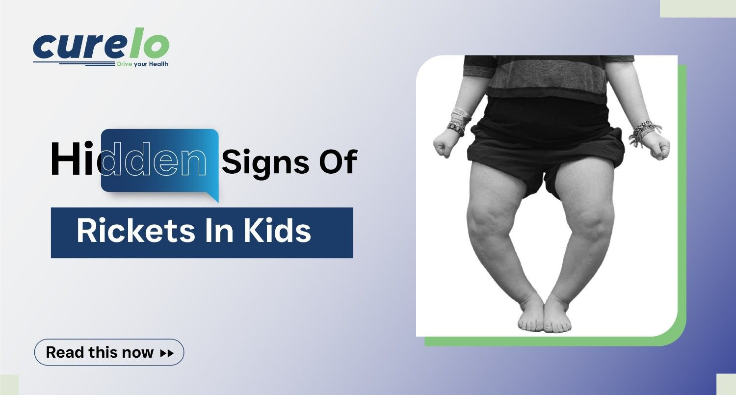 Rickets Disease: Signs, Vitamin D Guide & Prevention Illustration of healthy bones vs. bones affected by rickets showing curvature and softening.