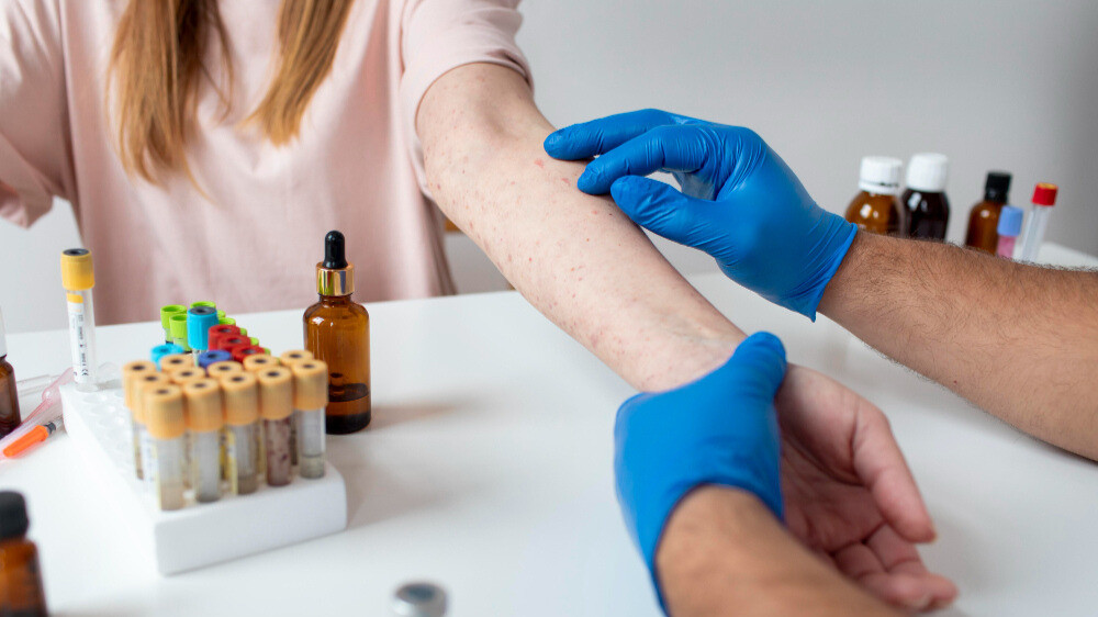 Dengue & Malaria Season Alert: Get Your Blood Test Done Before Monsoon Arrives