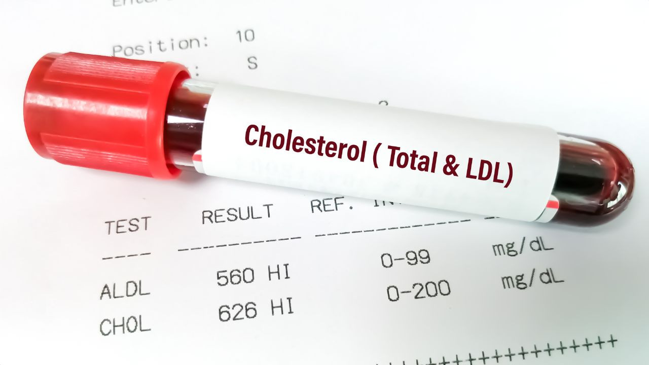 The Alarming Rise of High Cholesterol in People Under 30